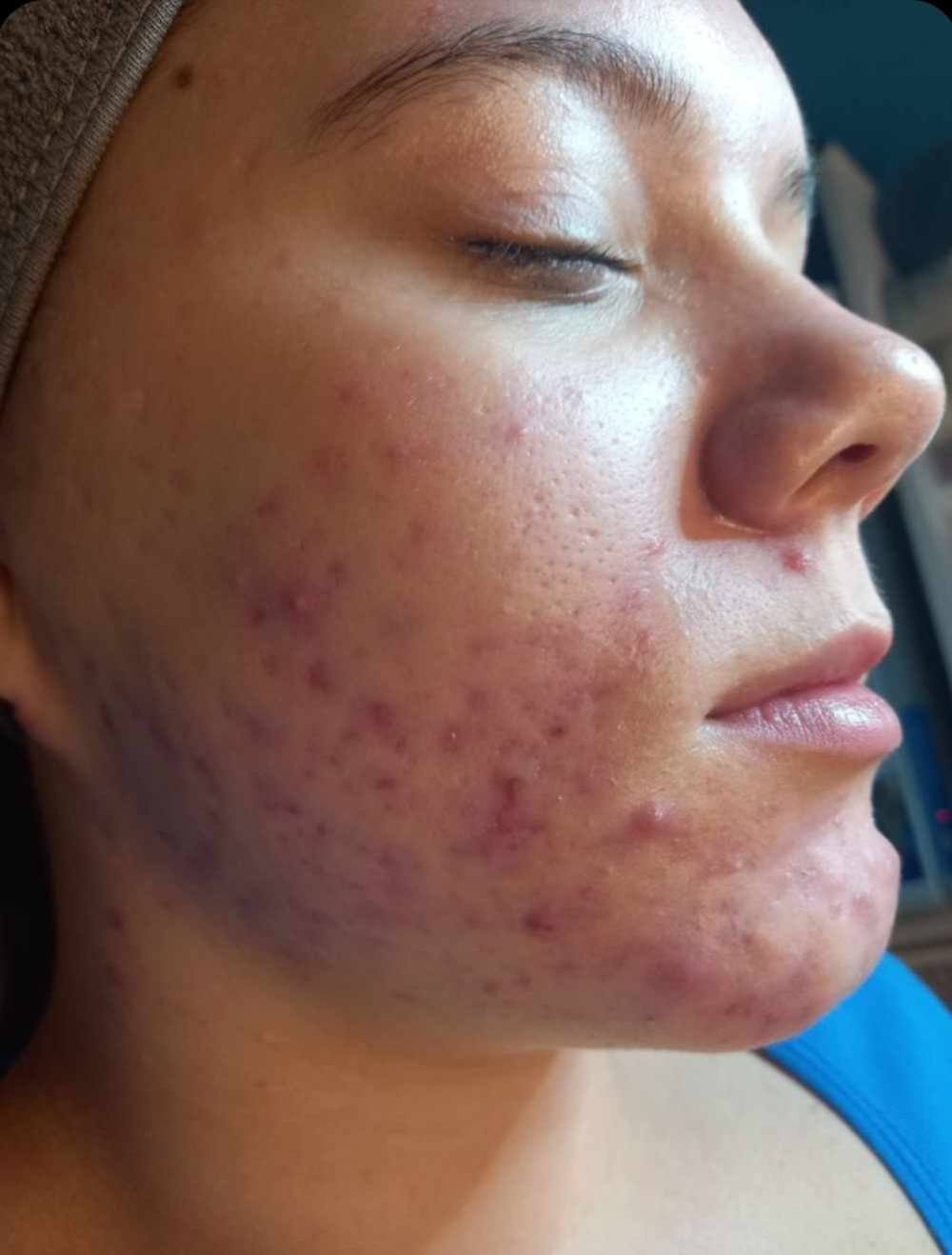 March Beautique Microdermabrasion Acne before