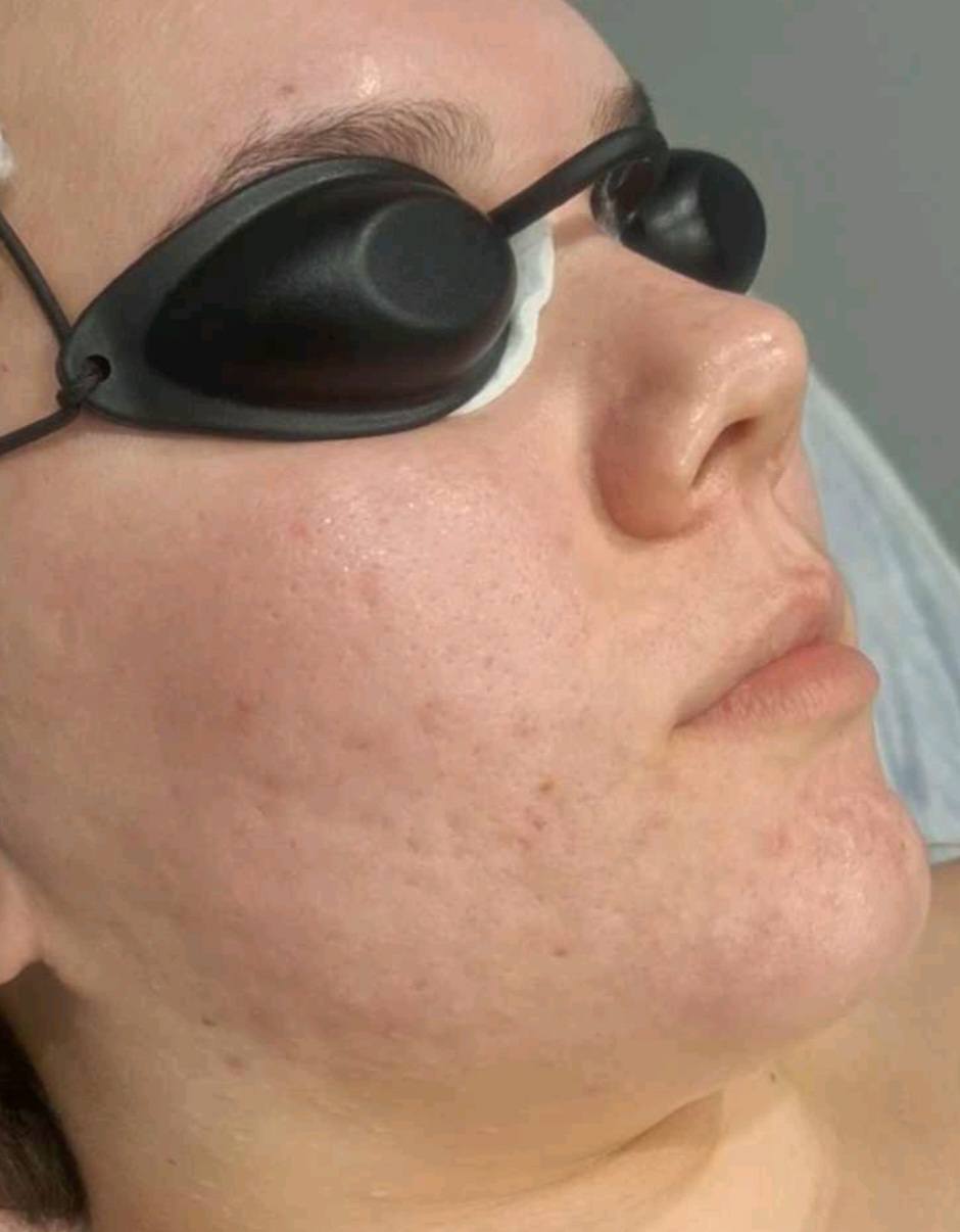 March Beautique Microdermabrasion Acne after