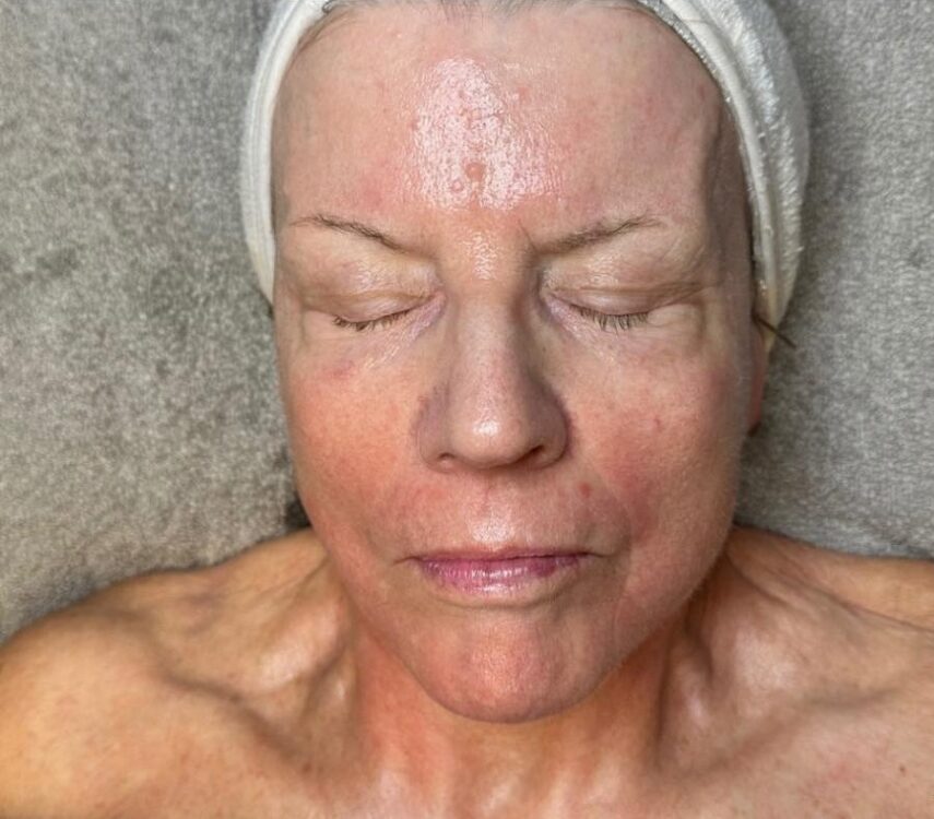 March Bronze Inc Collagen Lift for ageing skin radio frequency facial results after