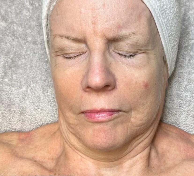 March Bronze Inc Collagen Lift for ageing skin radio frequency facial results before
