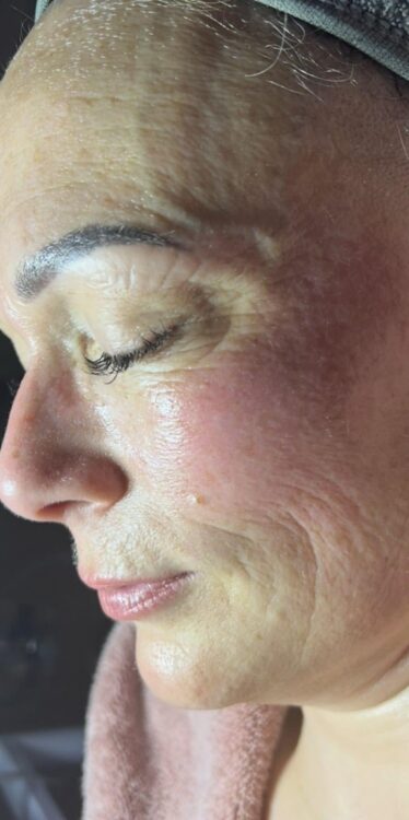 March DB Skin Therapy Hydro ageing skin face before