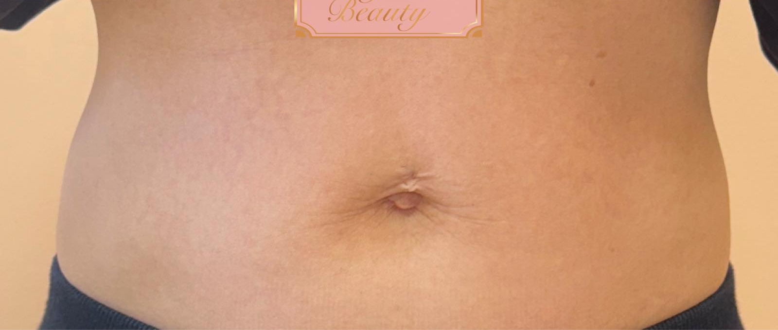 March Elegance Beauty Margate Collagen Lift tummy transformation loose skin laxity results after