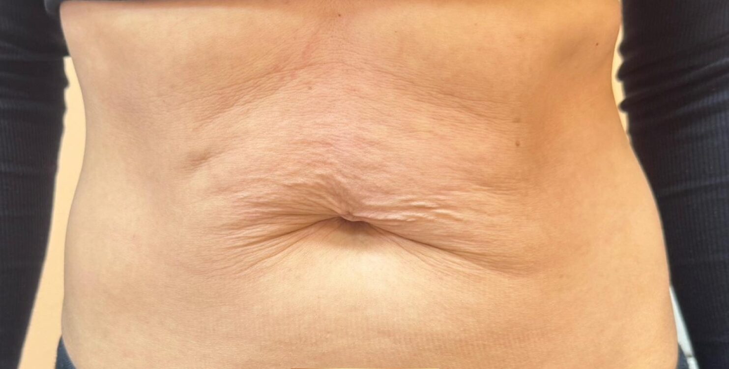 March Elegance Beauty Margate Collagen Lift tummy transformation loose skin laxity results before