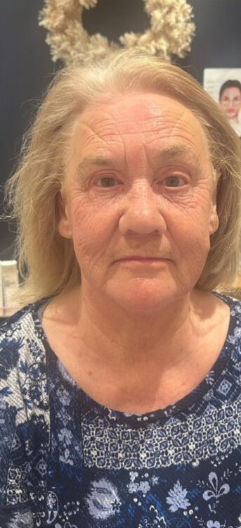 March Entries Glowtox Aesthetics Collagen Lift ageing skin facial results after
