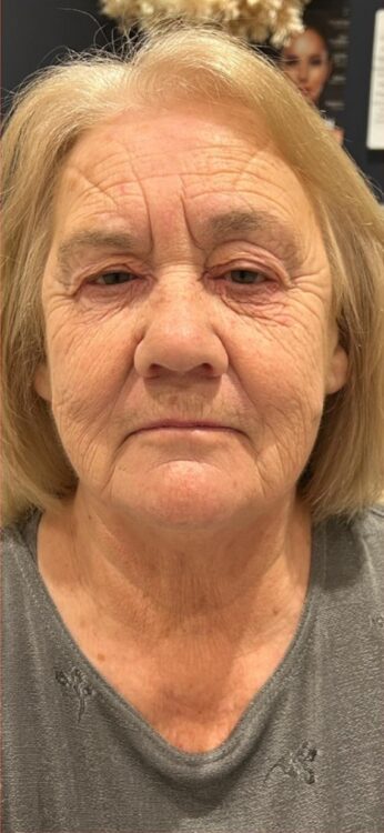 March Entries Glowtox Aesthetics Collagen Lift ageing skin facial results before