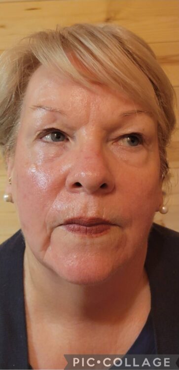 March Personalised Beauty by Fiona Collagen Lift radio frequency facial ageing skin results after