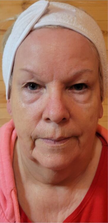 March Personalised Beauty by Fiona Collagen Lift radio frequency facial ageing skin results before