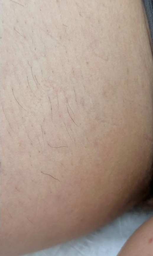 March Resolve and Restore Intense pulsed light unwanted hair after