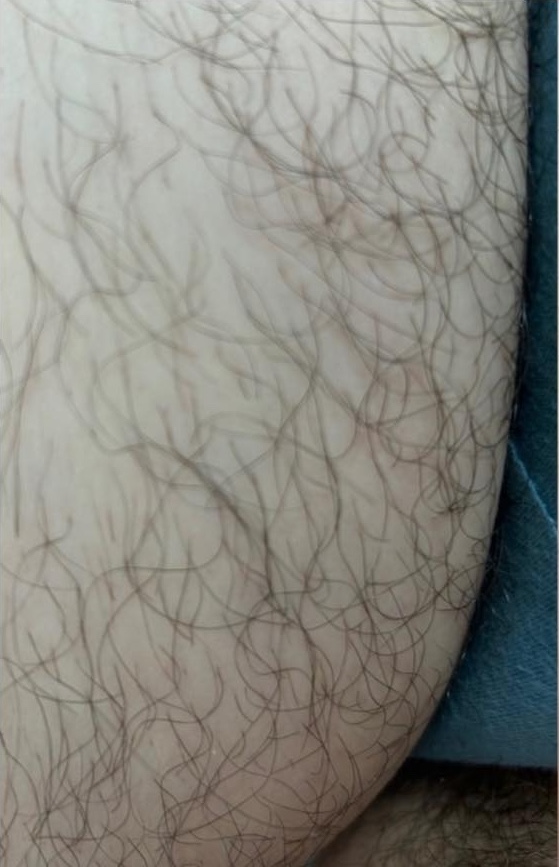 March Resolve and Restore Intense pulsed light unwanted hair before