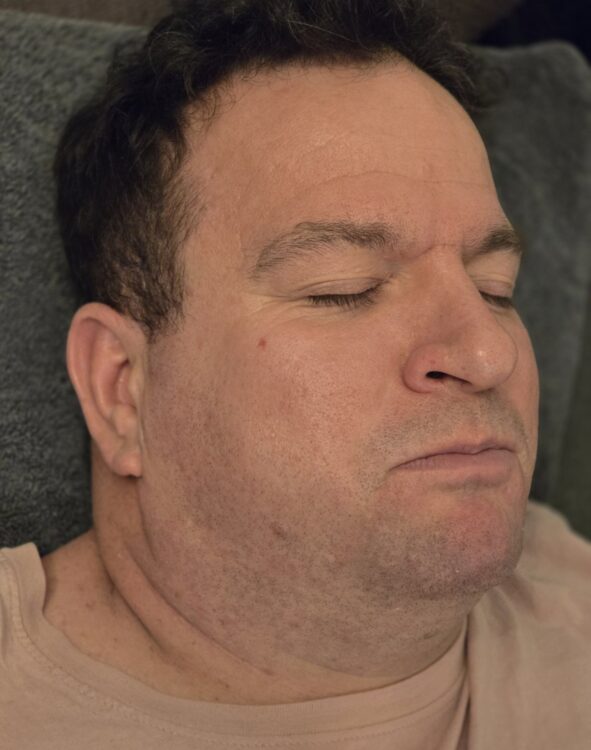 March The Beauty Room Birmingham Collagen Lift male radio frequency transformation before