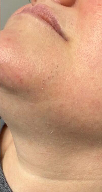 March Wood and Co Salon and Training unwanted hair face intense pulsed light results after