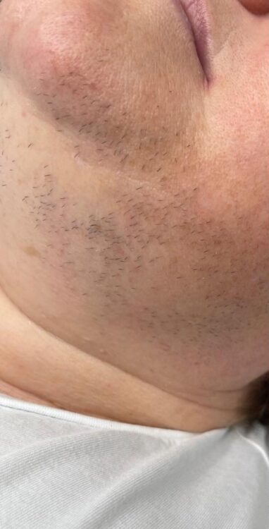March Wood and Co Salon and Training unwanted hair face intense pulsed light results before
