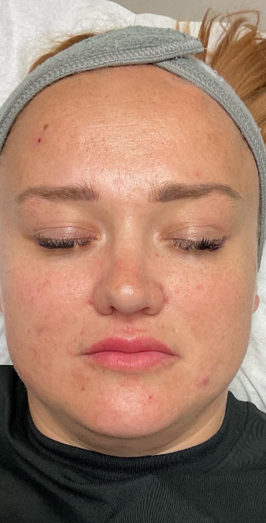 May Auream Aesthetics Microdermabrasion acne facial after