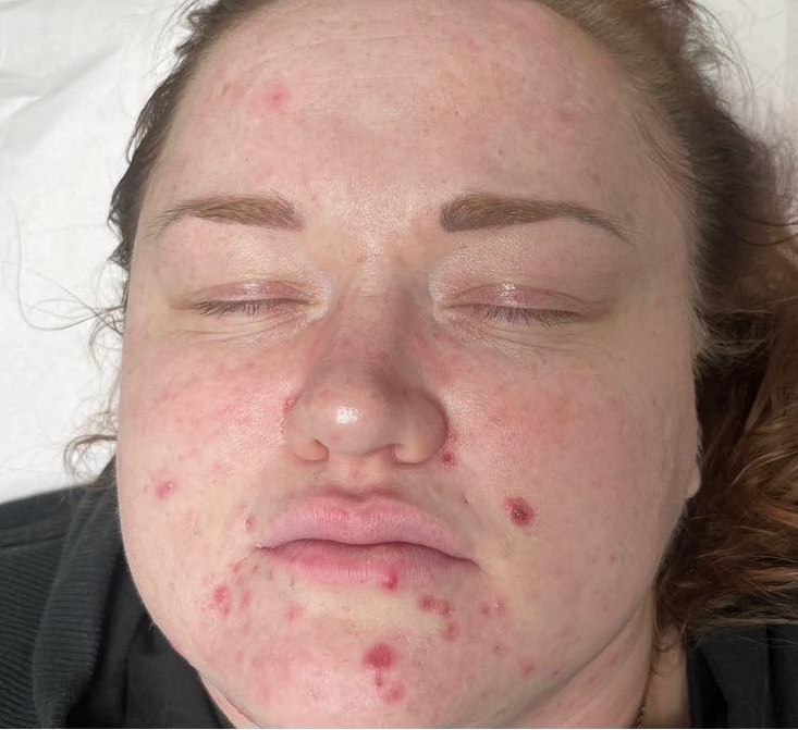 May Auream Aesthetics Microdermabrasion acne facial before