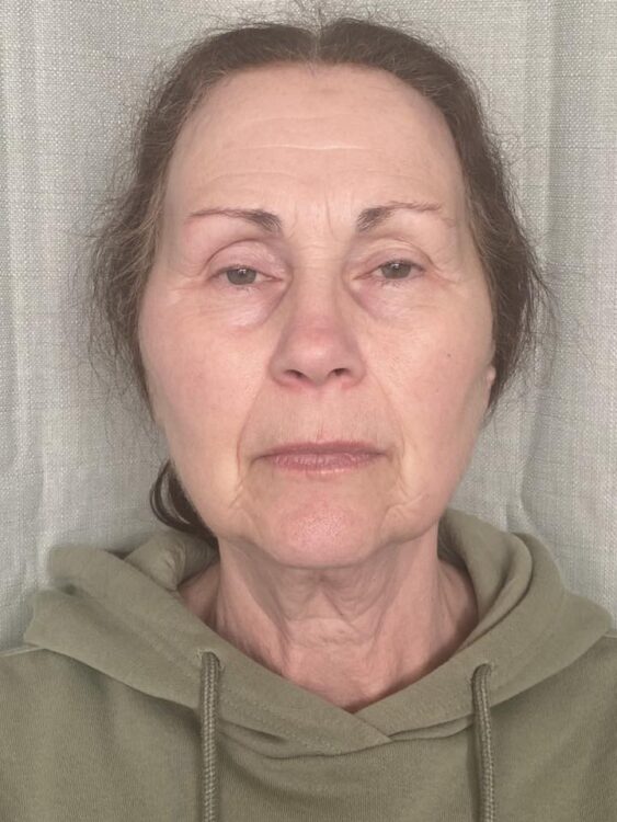 May NB Nails Holistics Beauty Collagen Lift Microdermabrasion ageing skin rejuvenation before