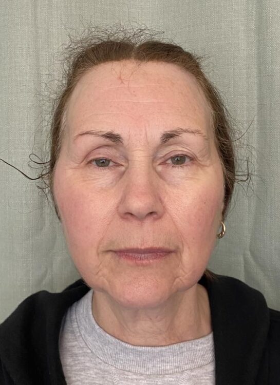 May NB Nails Holistics Beauty Collagen Lift Microdermabrasion ageing skin rejuvenation after