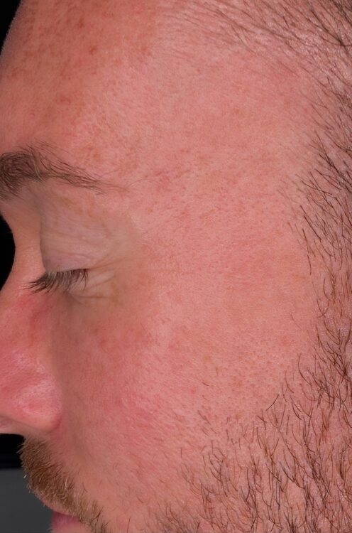 May Rebecca Willshee Skin Specialist Male Microdermabrasion collagen lift hydro skin rejuvenation groom wedding prep after