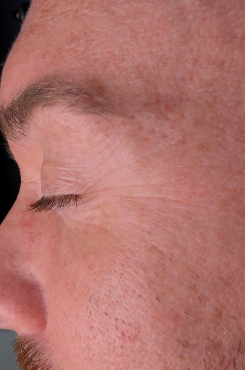 May Rebecca Willshee Skin Specialist Male Microdermabrasion collagen lift hydro skin rejuvenation groom wedding prep before
