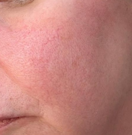 May Serenity Health and Beauty intense pulsed light vascular concerns and redness after