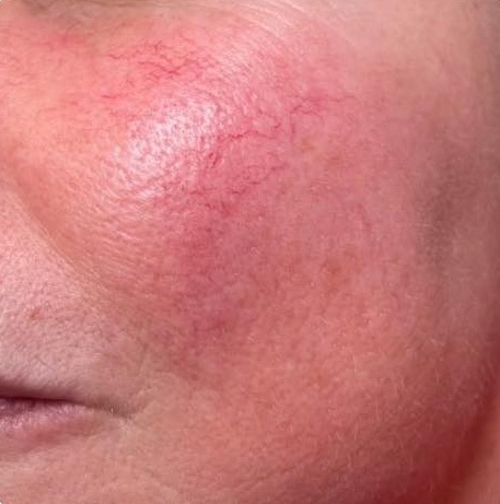 May Serenity Health and Beauty intense pulsed light vascular concerns and redness before