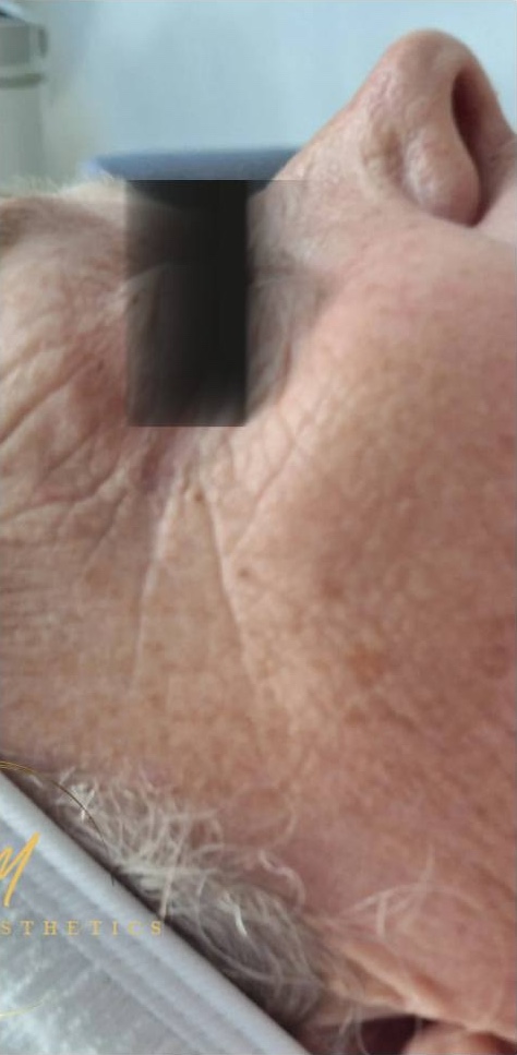 November AJM aesthetics Collagen Lift wrinkles rejuvenation radio frequency treatment results after
