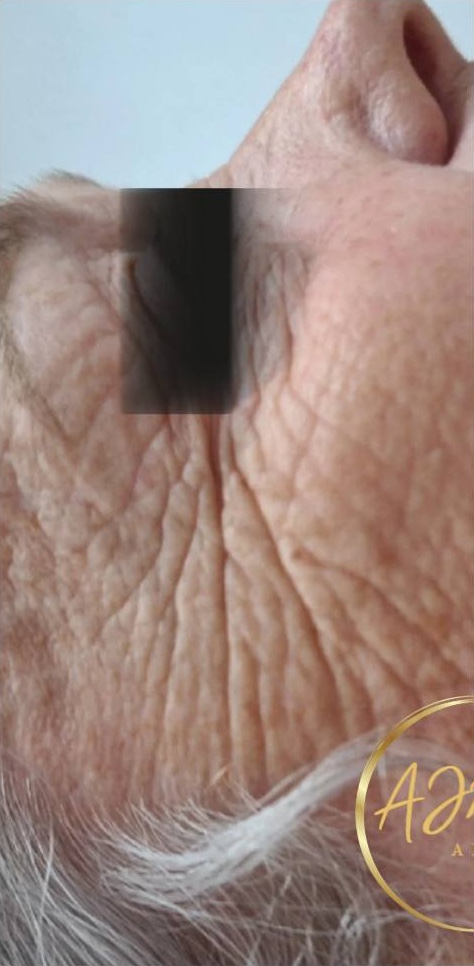 November AJM aesthetics Collagen Lift wrinkles rejuvenation radio frequency treatment results before