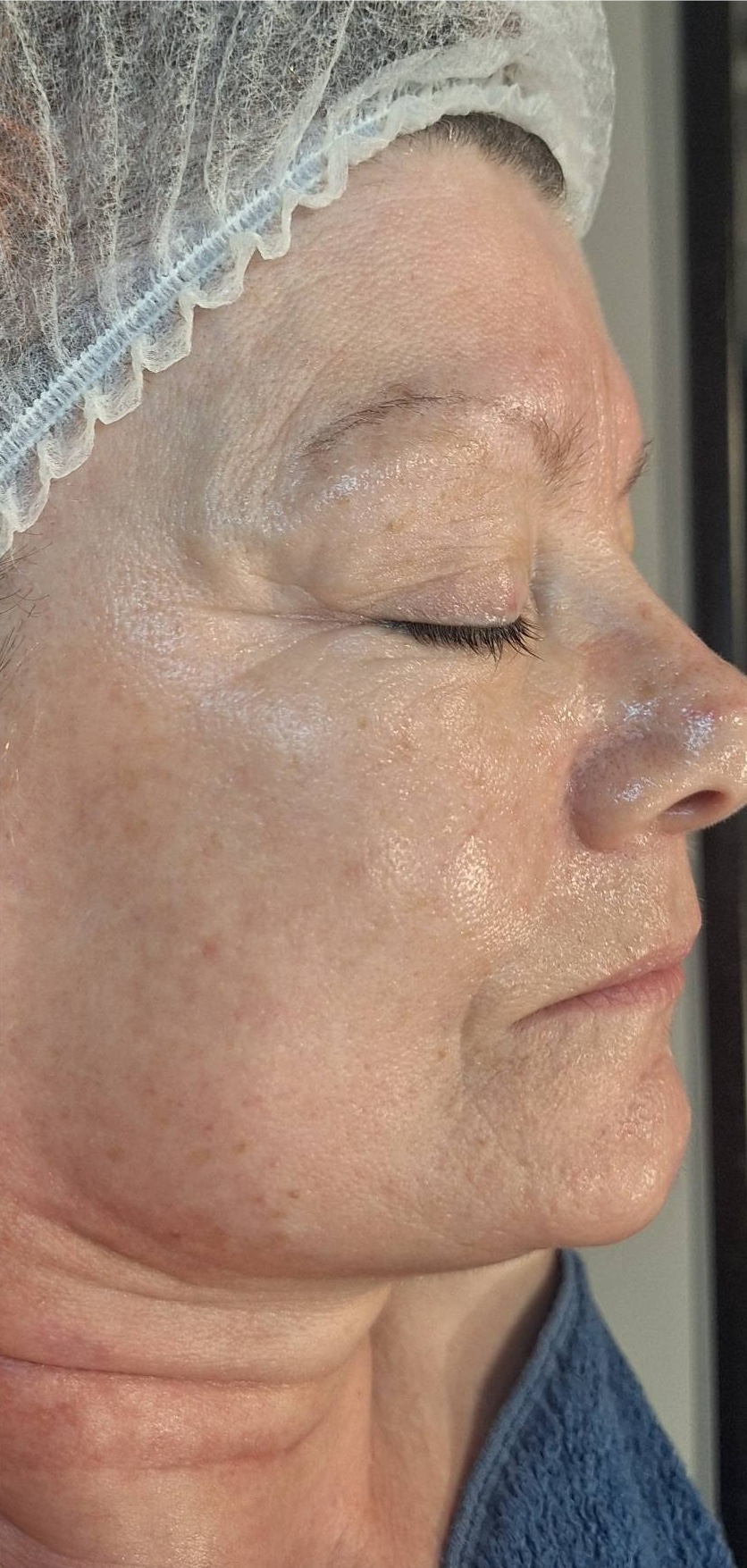 November Beautique Microdermabrasion Hydro Pigmentation Face after