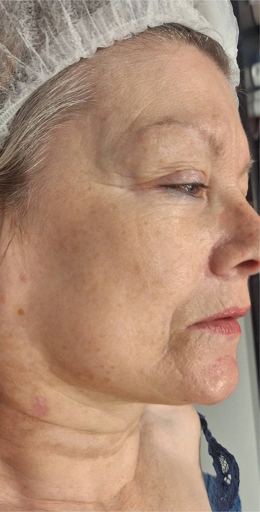 November Beautique Microdermabrasion Hydro Pigmentation Face before