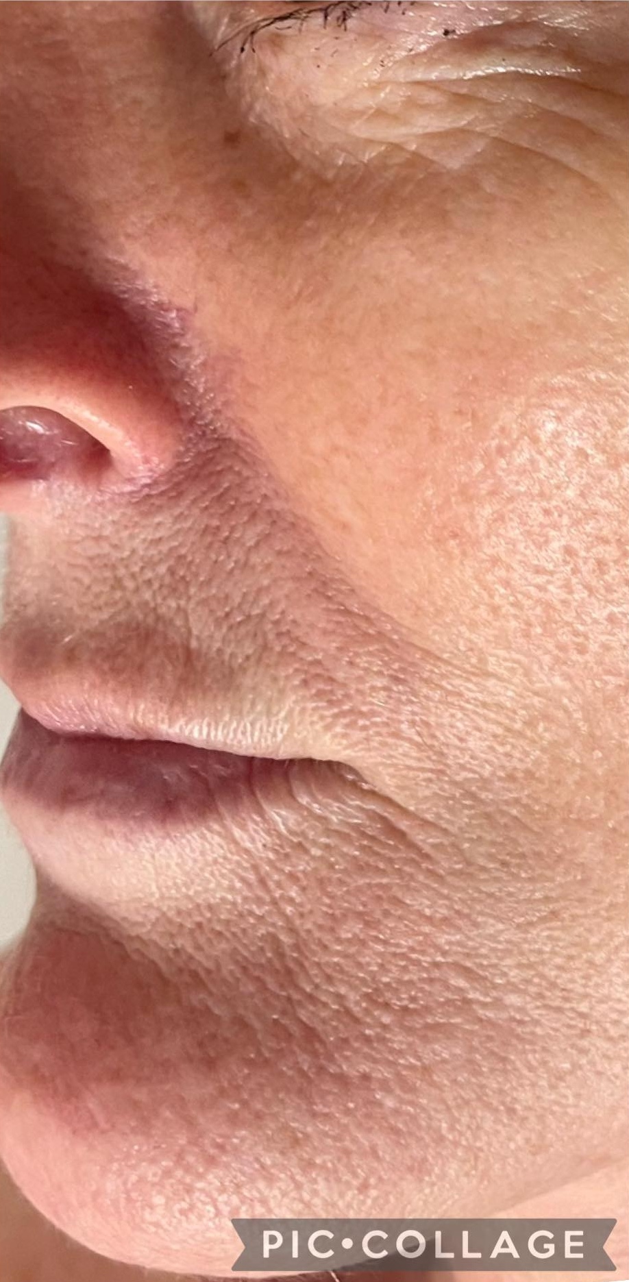 November Bijou Beauty Room ageing skin non surgical solution collagen lift intense pulsed light after