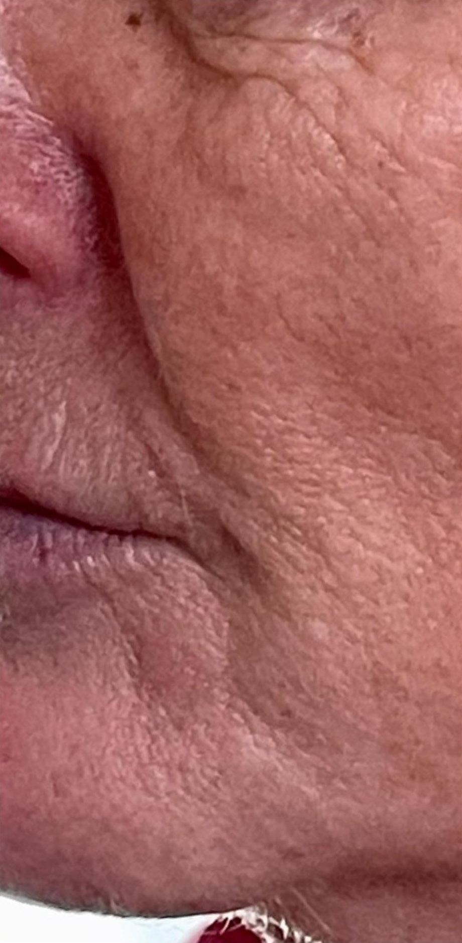 November Bijou Beauty Room ageing skin non surgical solution collagen lift intense pulsed light before