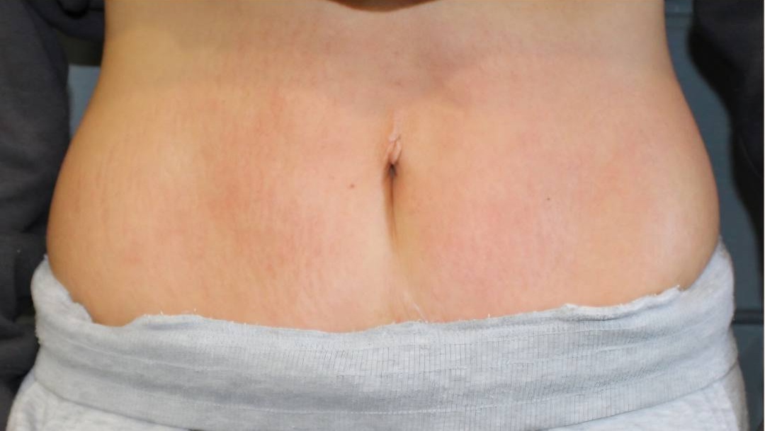 November Lash Brows Ashleen Allen Collagen Lift Tummy transformation radio frequency skin firming after