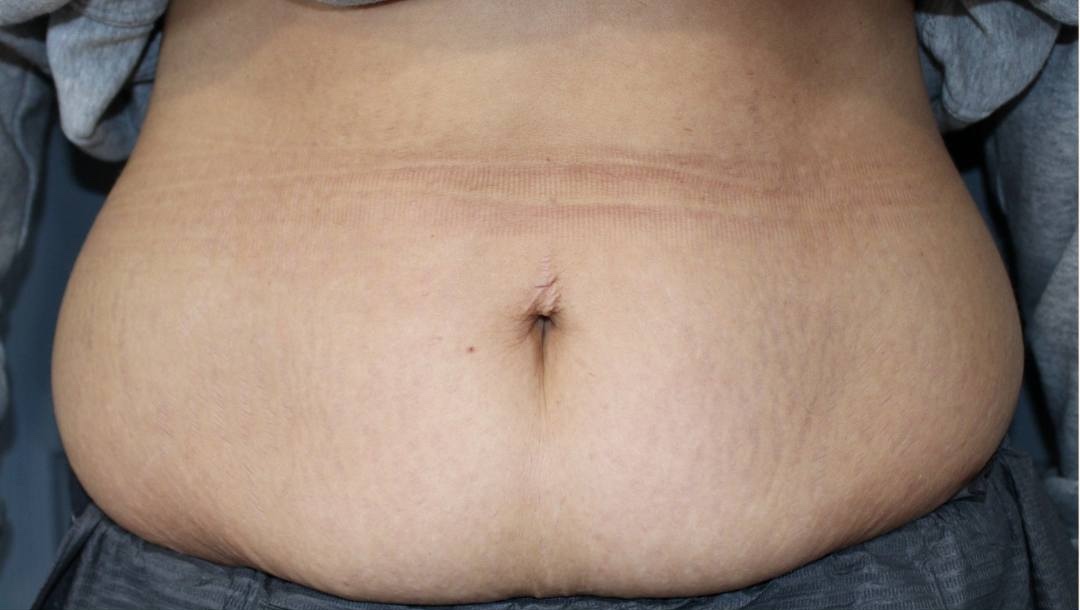 November Lash Brows Ashleen Allen Collagen Lift Tummy transformation radio frequency skin firming before