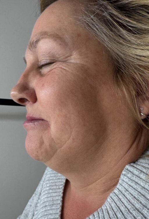 November The Beauty Edit Collagen Lift Ageing Skin fine lines and wrinkles rejuvenation before