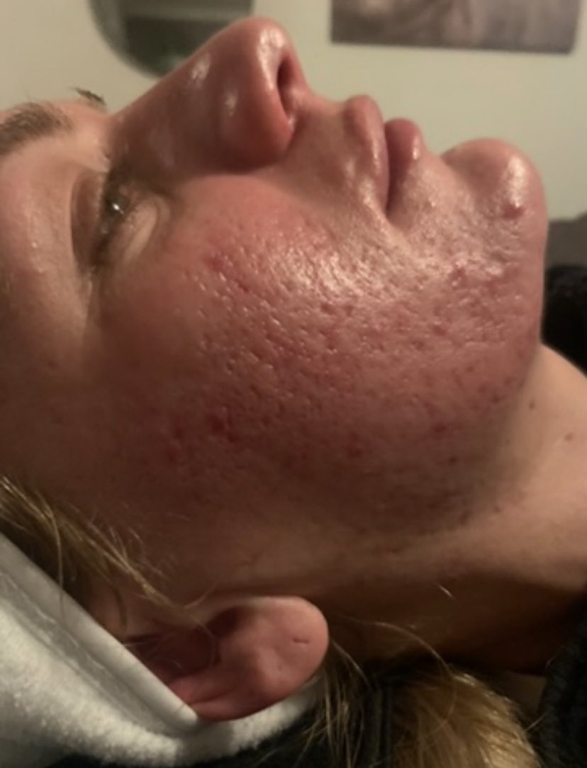 November The Blissful Beauty Company Microdermabrasion Collagen Lift acne face before