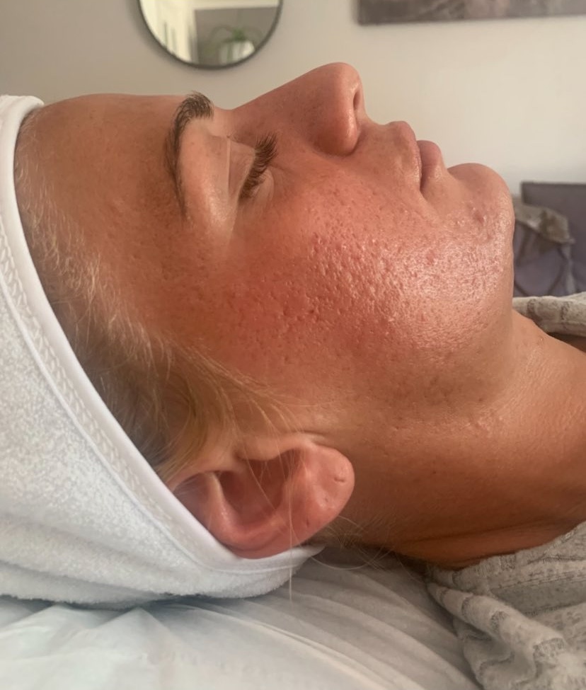 November The Blissful Beauty Company Microdermabrasion Collagen Lift acne face after