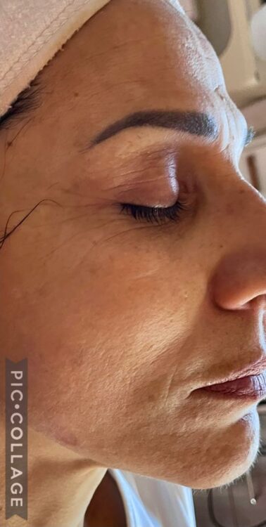 October Bijou Beauty Room Intense Pulsed Light Photorejuvenation Facial Pigmentation after