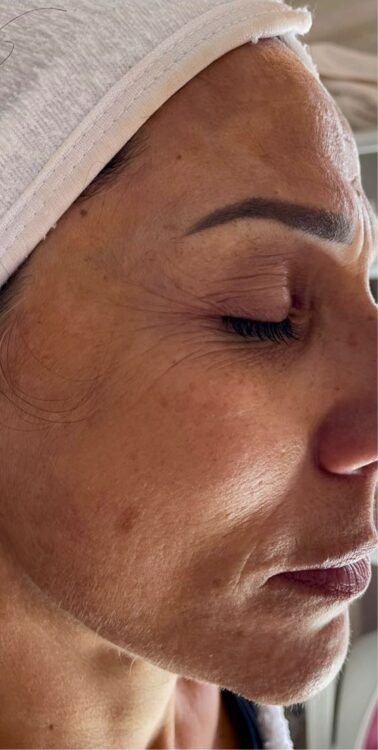 October Bijou Beauty Room Intense Pulsed Light Photorejuvenation Facial Pigmentation before