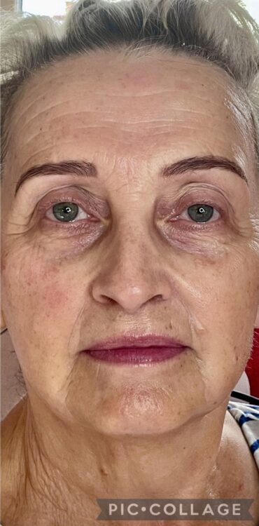 October Bijou Beauty Room Collagen Lift ageing skin rejuvenation SkinBase radio frequency treatment after