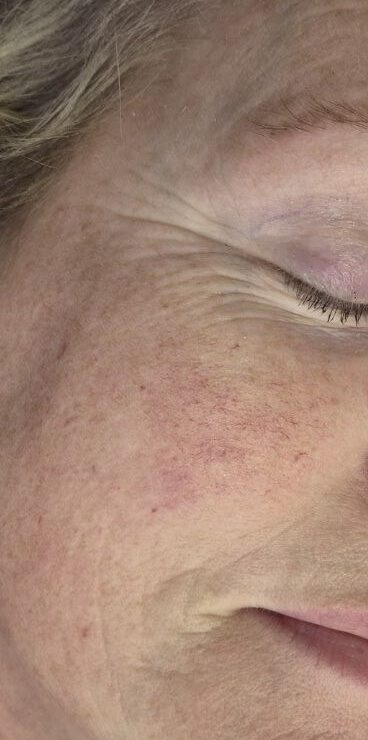 October Hidden Beauty Arva Collagen Lift youthful skin boost radio frequency before