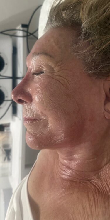October Katherine Monique Beauty Collagen Lift ageing skin rejuvenation after