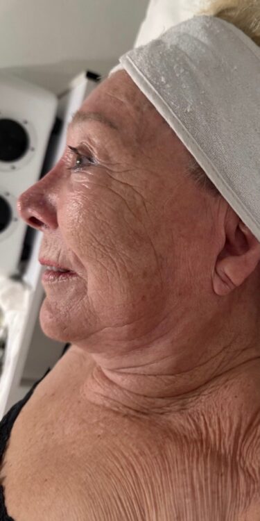 October Katherine Monique Beauty Collagen Lift ageing skin rejuvenation before