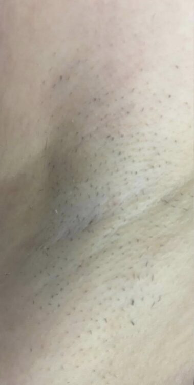 October Lauren's Beauty and Massage IPL unwanted Hair Underarm before