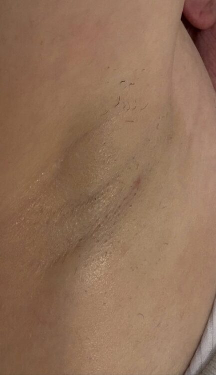 October Lauren's Beauty and Massage IPL unwanted Hair Underarm after