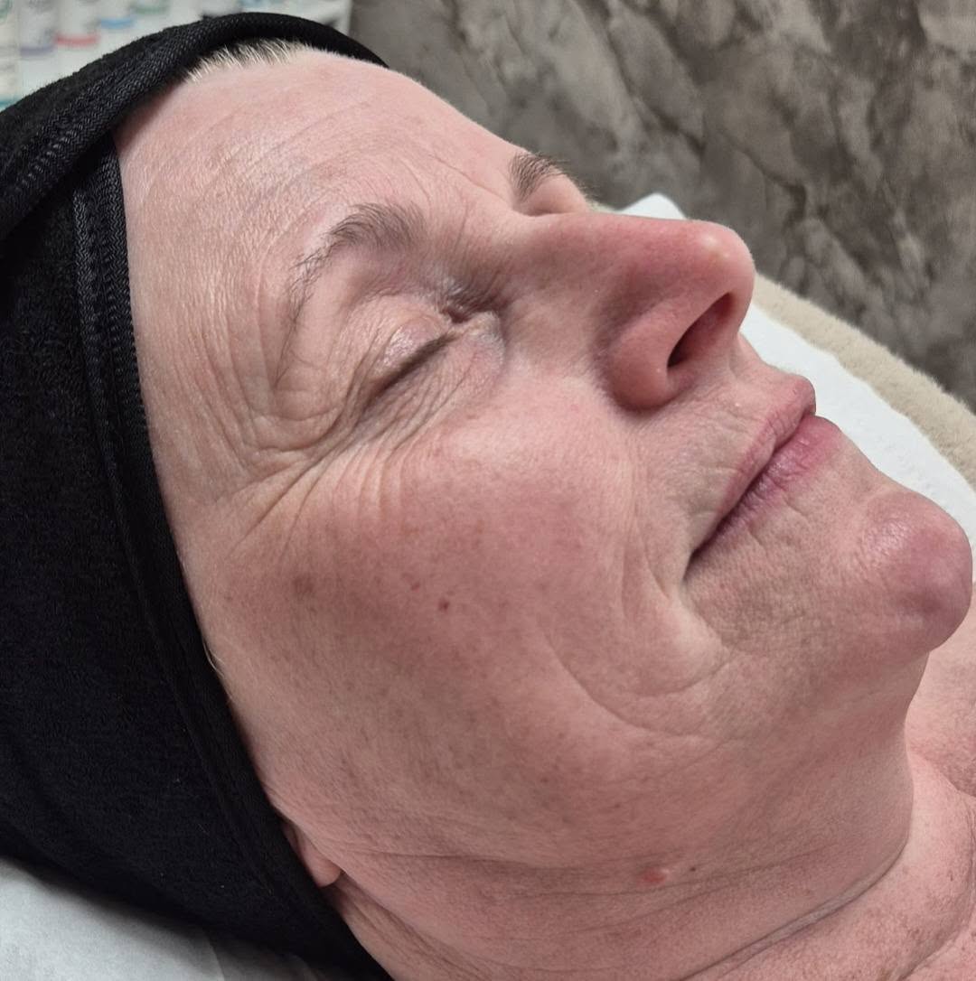 October Nicola Hansom Beauty Microdermabrasion face ageing skin before