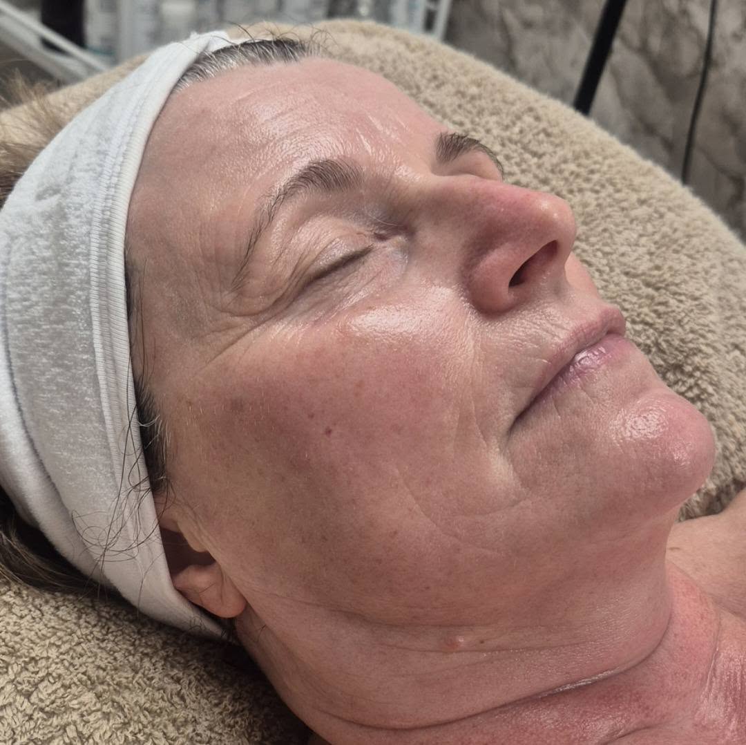 October Nicola Hansom Beauty Microdermabrasion face ageing skin after