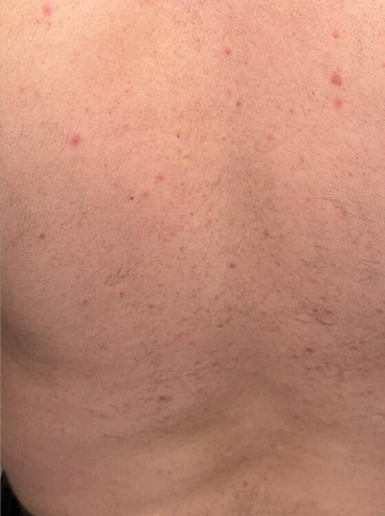 October Wood and Co Salon Intense pulsed light unwanted hair back after