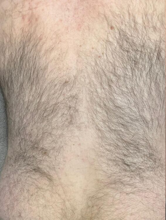 October Wood and Co Salon Intense pulsed light unwanted hair back before