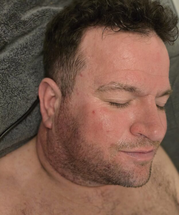March The Beauty Room Birmingham Collagen Lift male radio frequency transformation after
