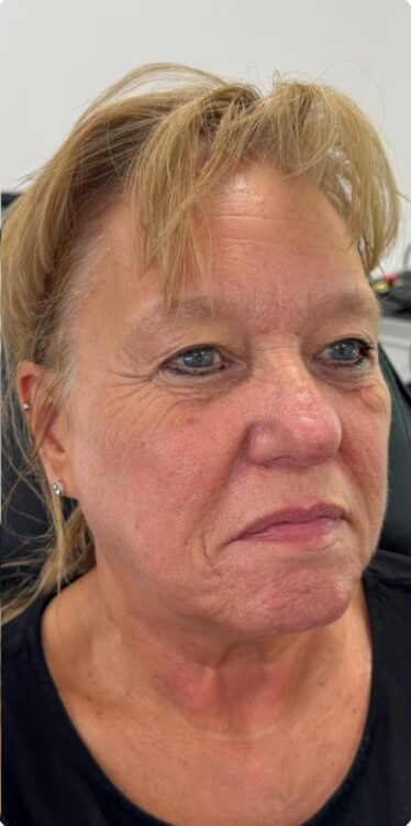 September Amber Ray Aesthetics Collagen Lift ageing skin rejuvenation after