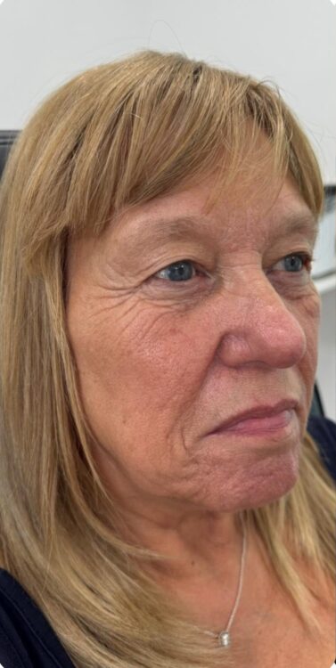 September Amber Ray Aesthetics Collagen Lift ageing skin rejuvenation before